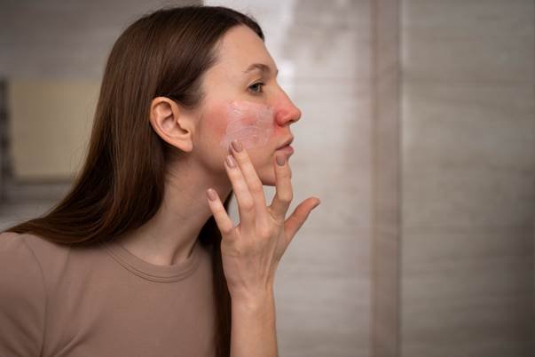 A woman applying a clear or slightly pink ointment to a large patch of severe red, irritated skin on her cheek, likely treating an allergic reaction, rash, or rosacea