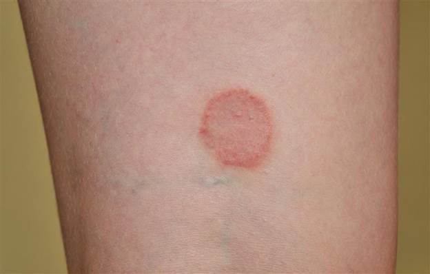 Close-up of human skin showing a circular, reddish rash with a raised outer ring and lighter center, resembling ringworm or a Lyme disease bull's-eye rash.
