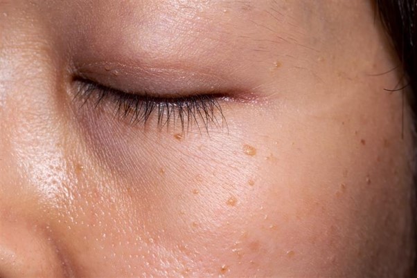 A Beginner’s Guide to Identifying Seborrheic Keratosis