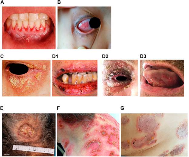 What Is Pemphigus Vulgaris? Symptoms, Causes, and First Steps