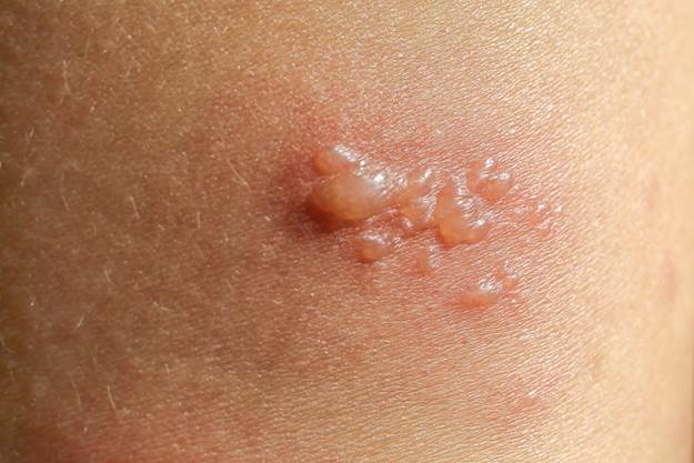 What is Actinic Keratosis? An In-depth Guide to Symptoms and Solutions
